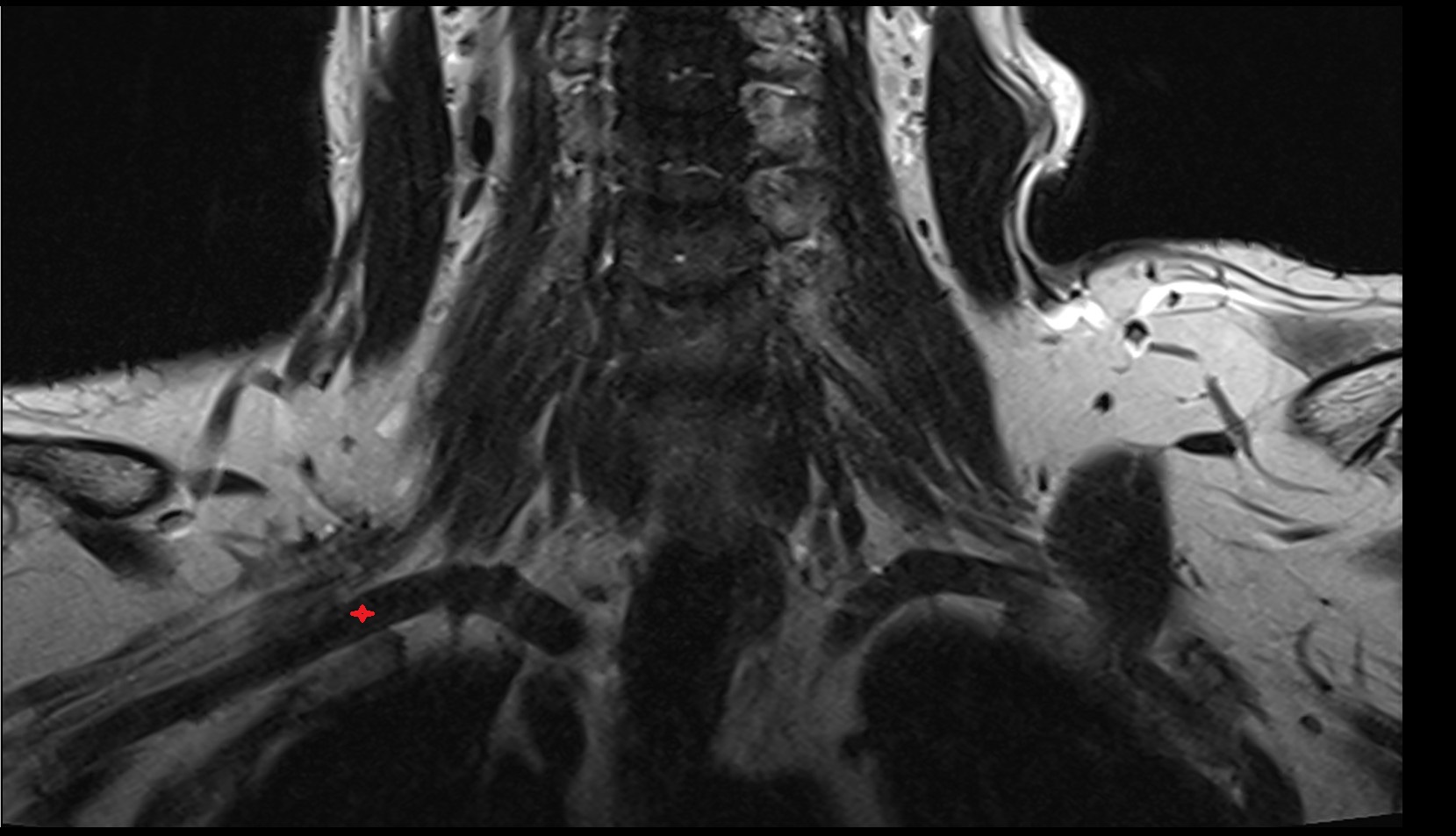 Right subclavian artery coronal image mri