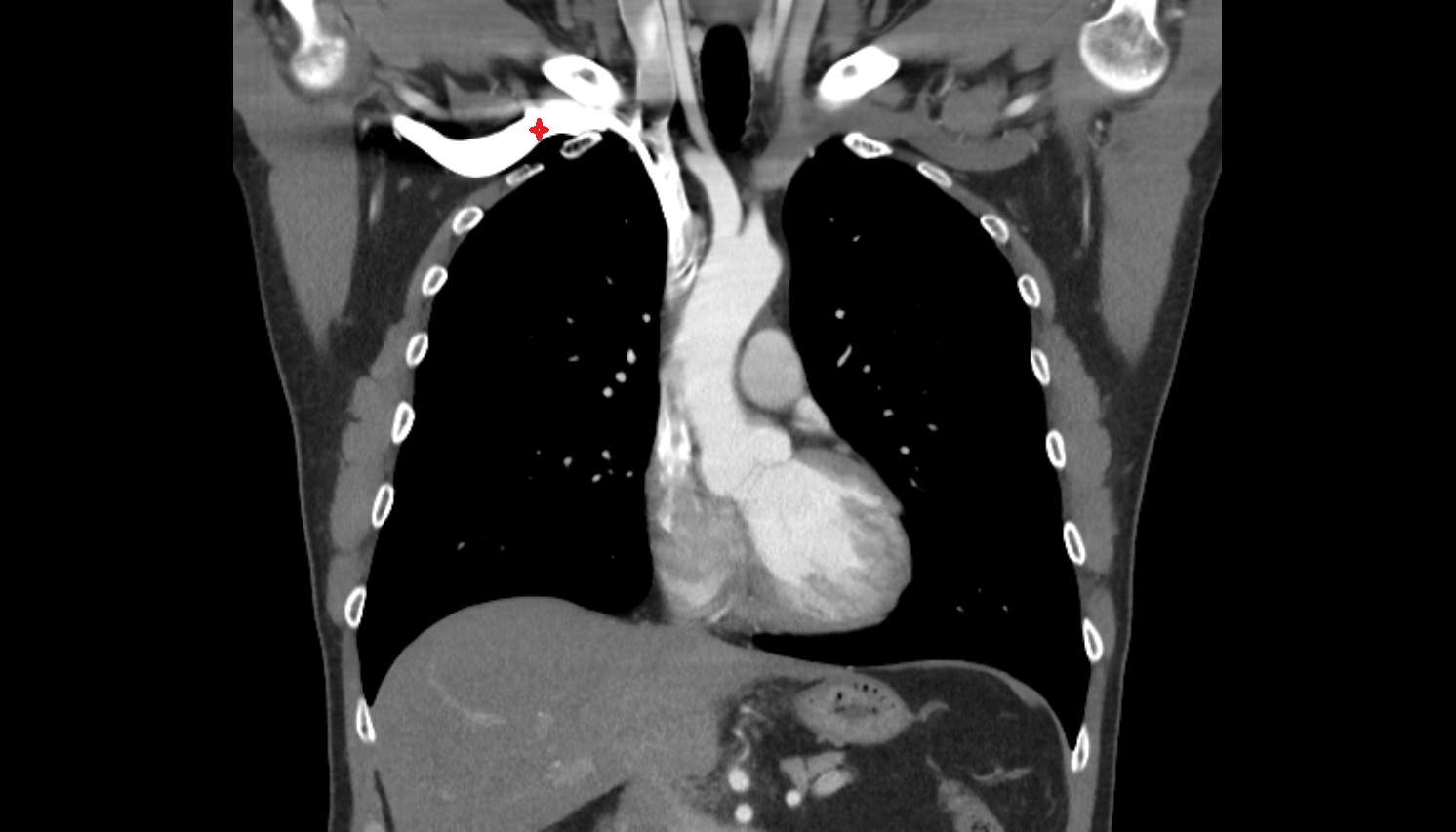 Right subclavian vein anatomy CORONAL CT  image -img-00000-00000