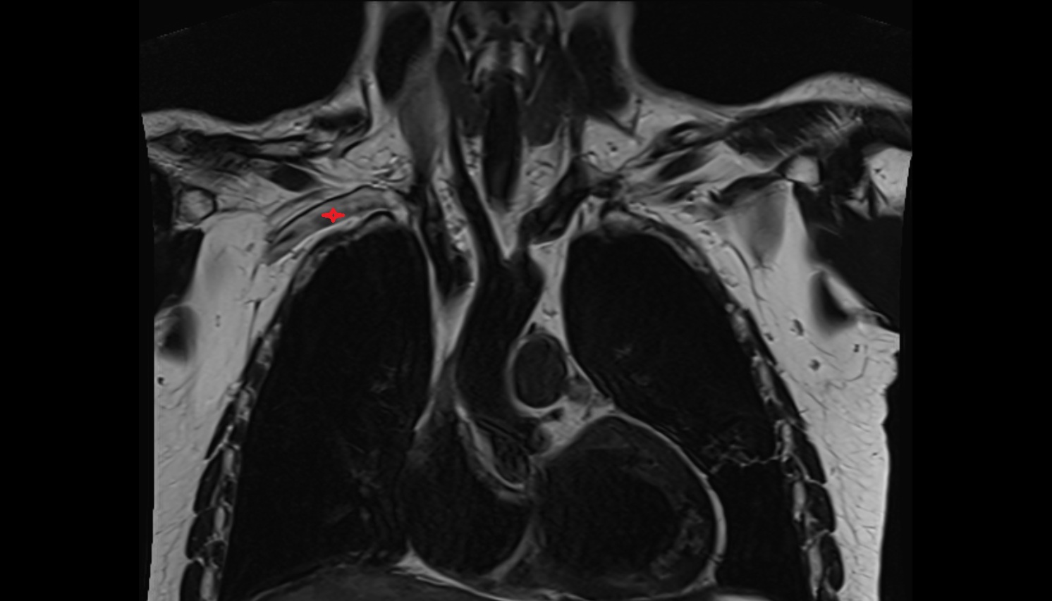 Right subclavian vein anatomy CORONAL MRI  image -img-00000-00000