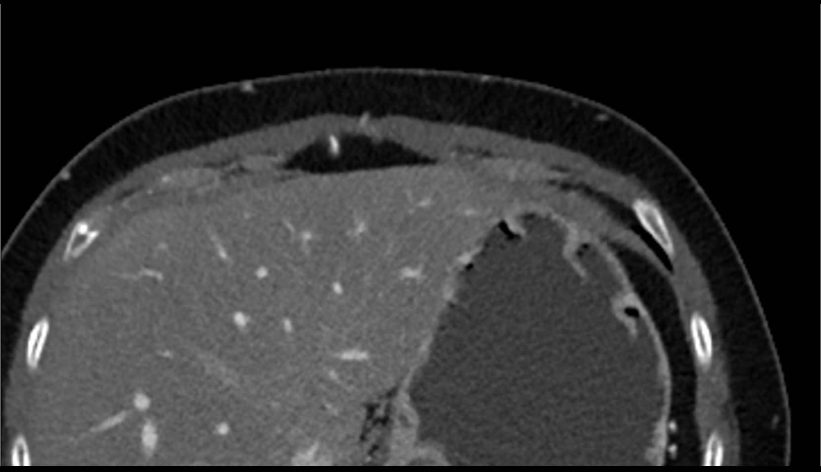 Right superior epigastric artery CT AXIAL IMAGE