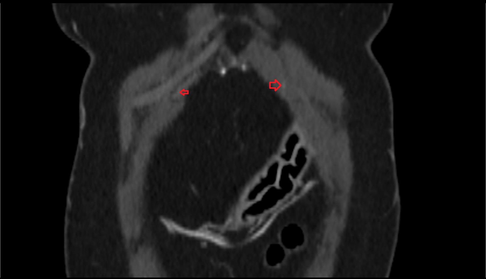 Right superior epigastric artery CT CORONAL IMAGE