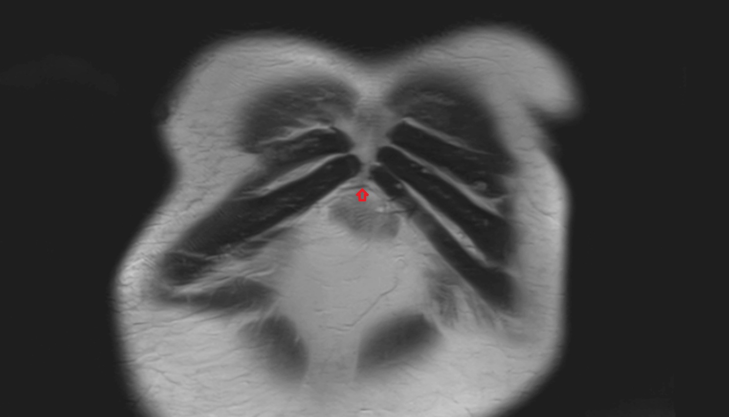 Right superior epigastric veins  MRI coronal  anatomy  image -img-00000-00000