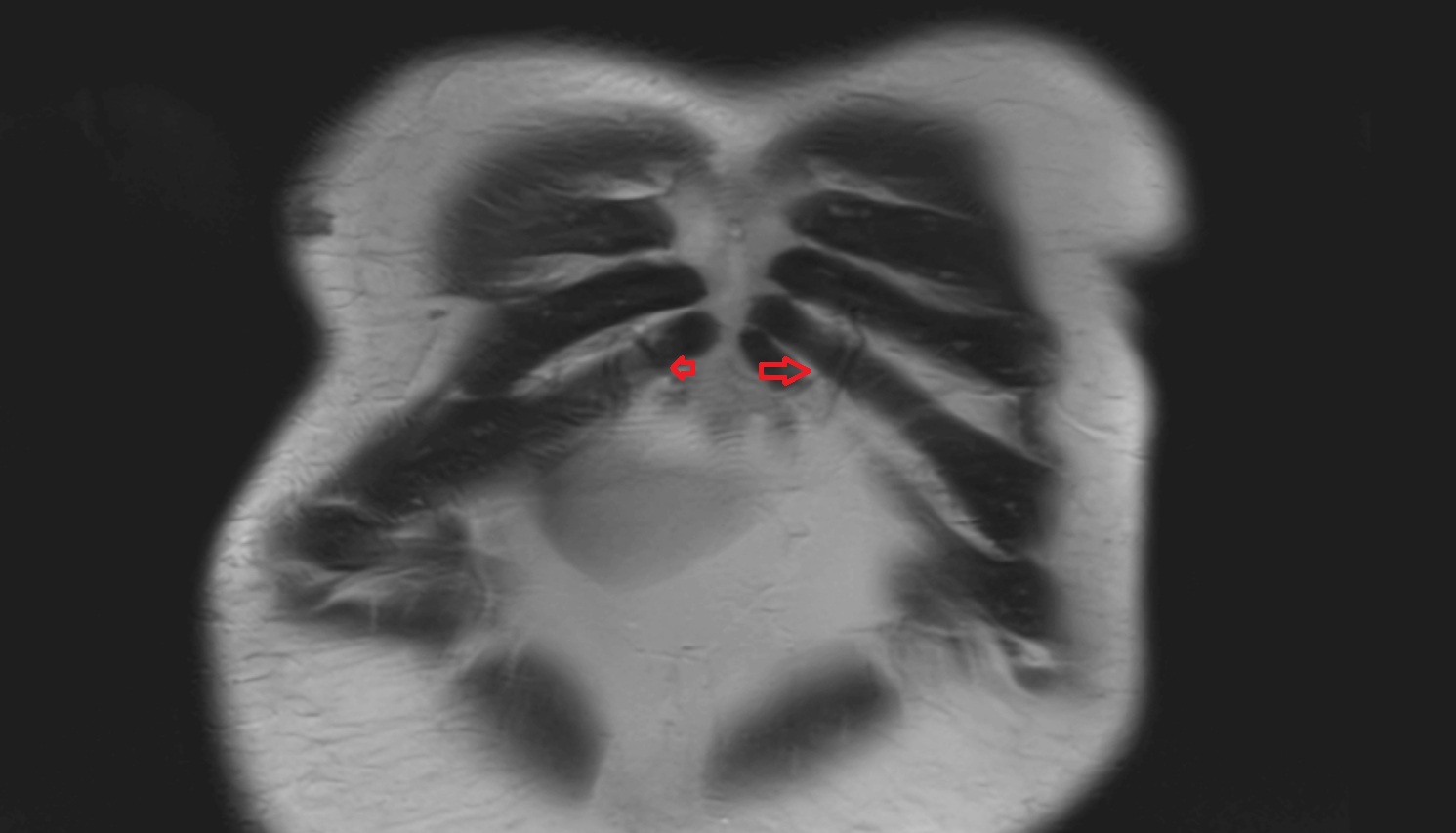 Right superior epigastric veins  MRI coronal  anatomy  image -img-00000-00000_00001