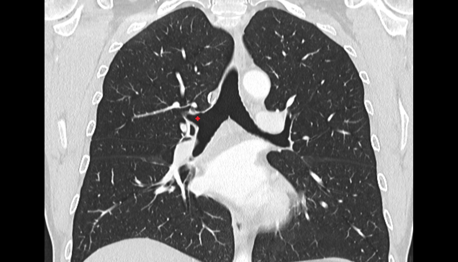 Right superior lobar bronchus  anatomy CT coronal  image -img-00000-00000