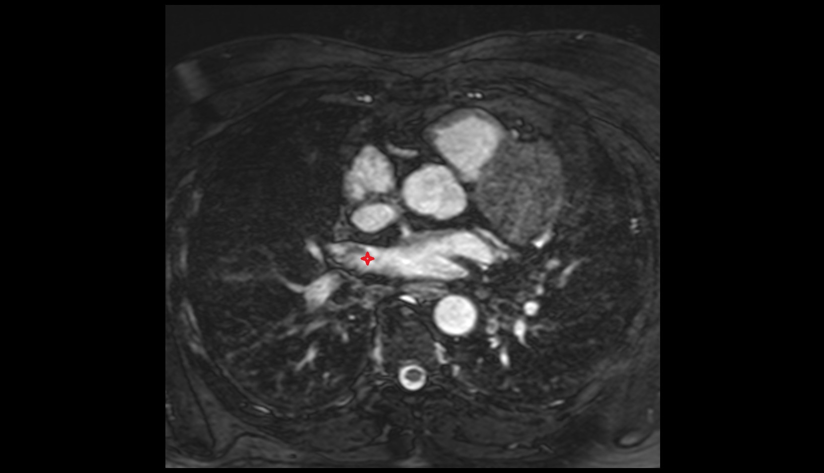 Right superior pulmonary vein MRI IMAGE
