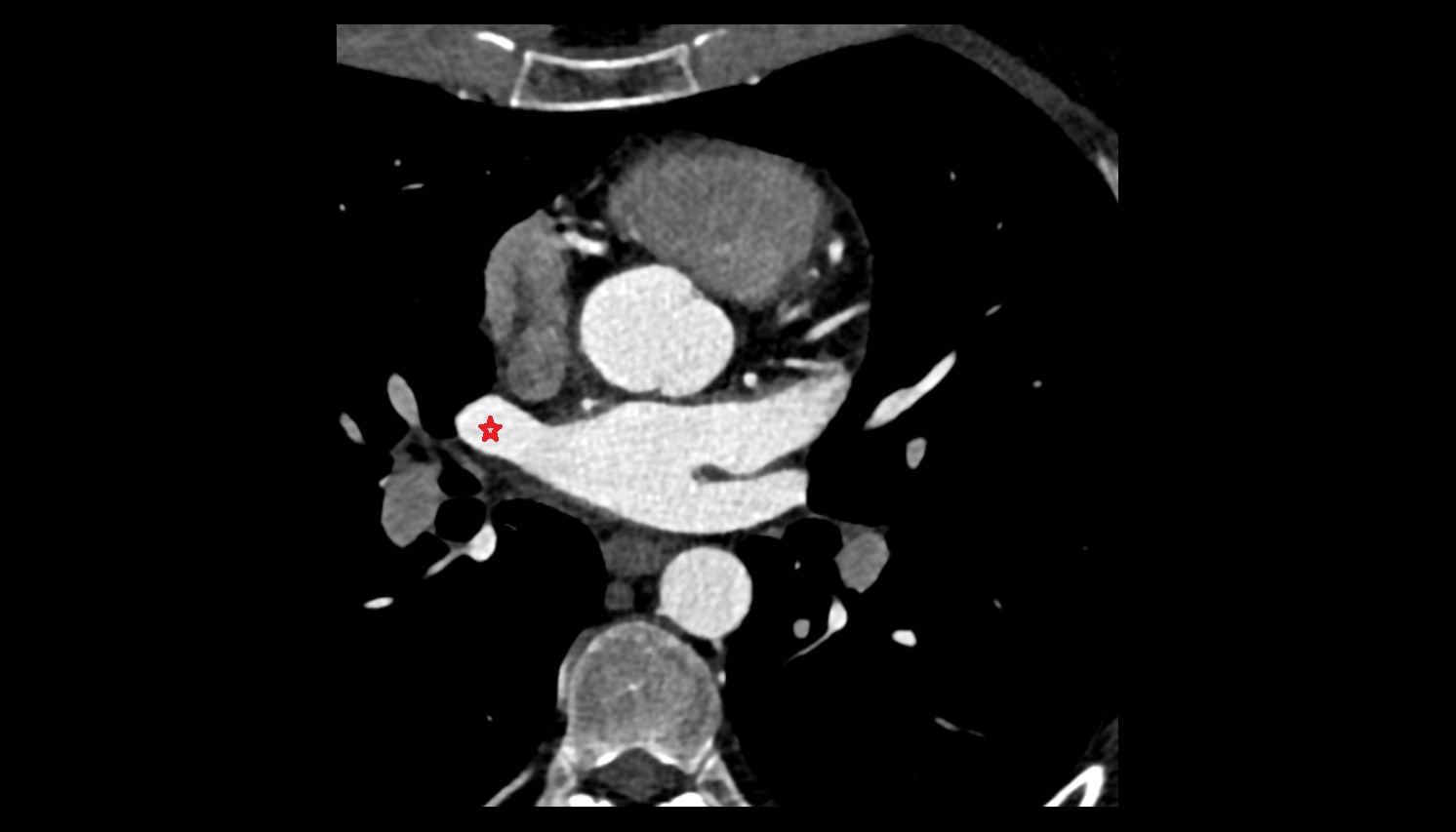 Right superior pulmonary vein  anatomy CT axial  image -img-00000-00000