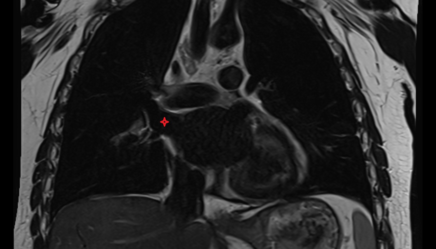 Right superior pulmonary vein  anatomy MRI coronal  image -img-00000-00000