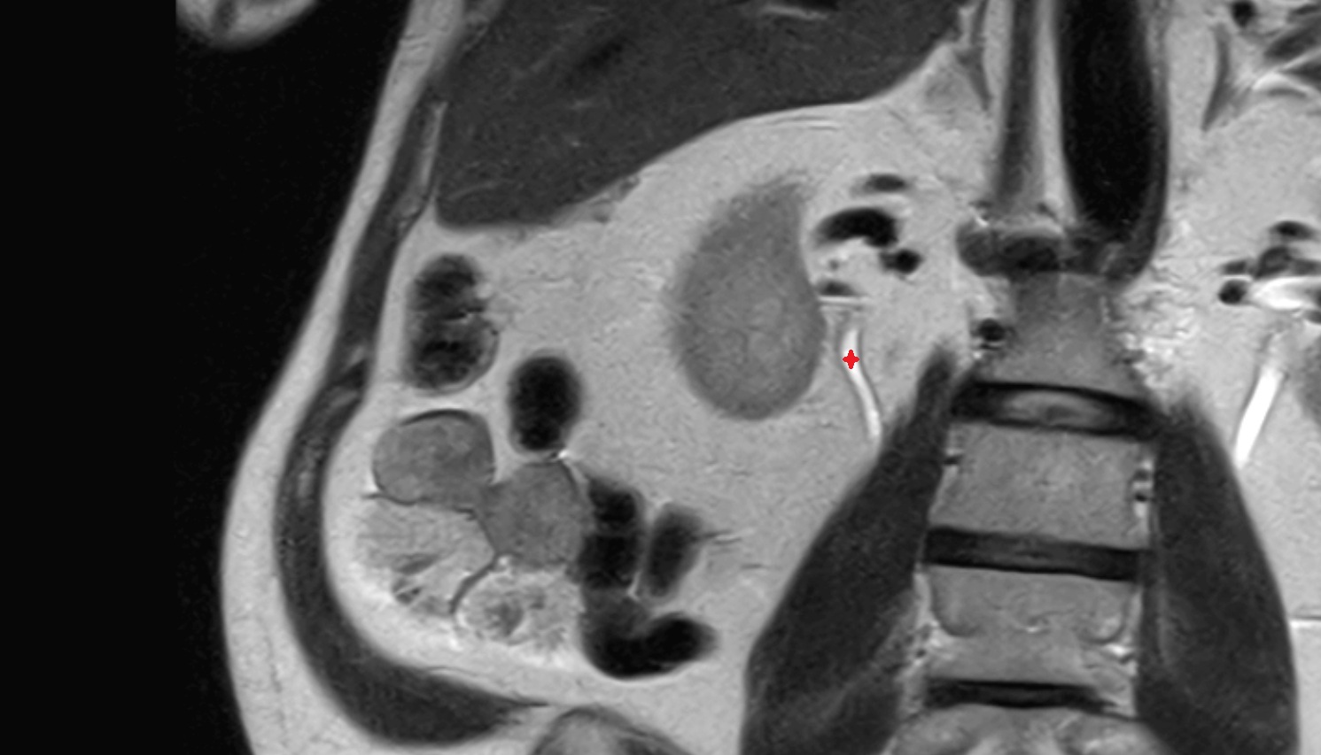 Right ureter  MRI coronal image anatomy  image -img-00000-00000