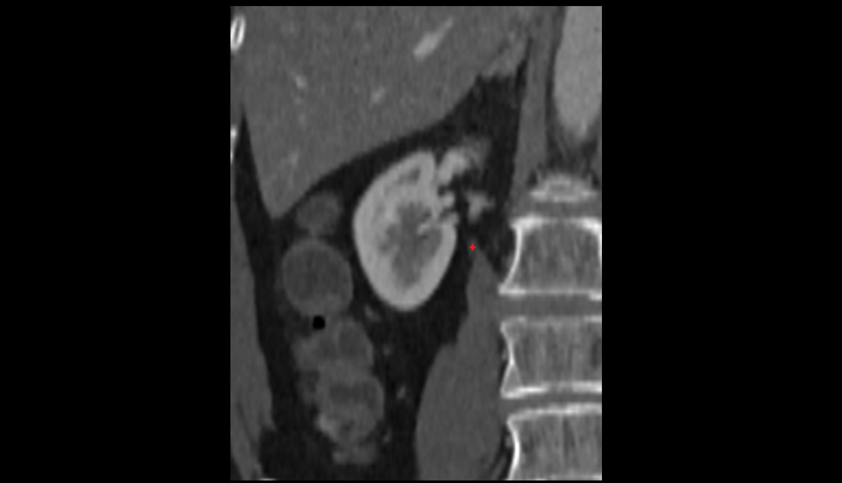 Right ureter coronal image