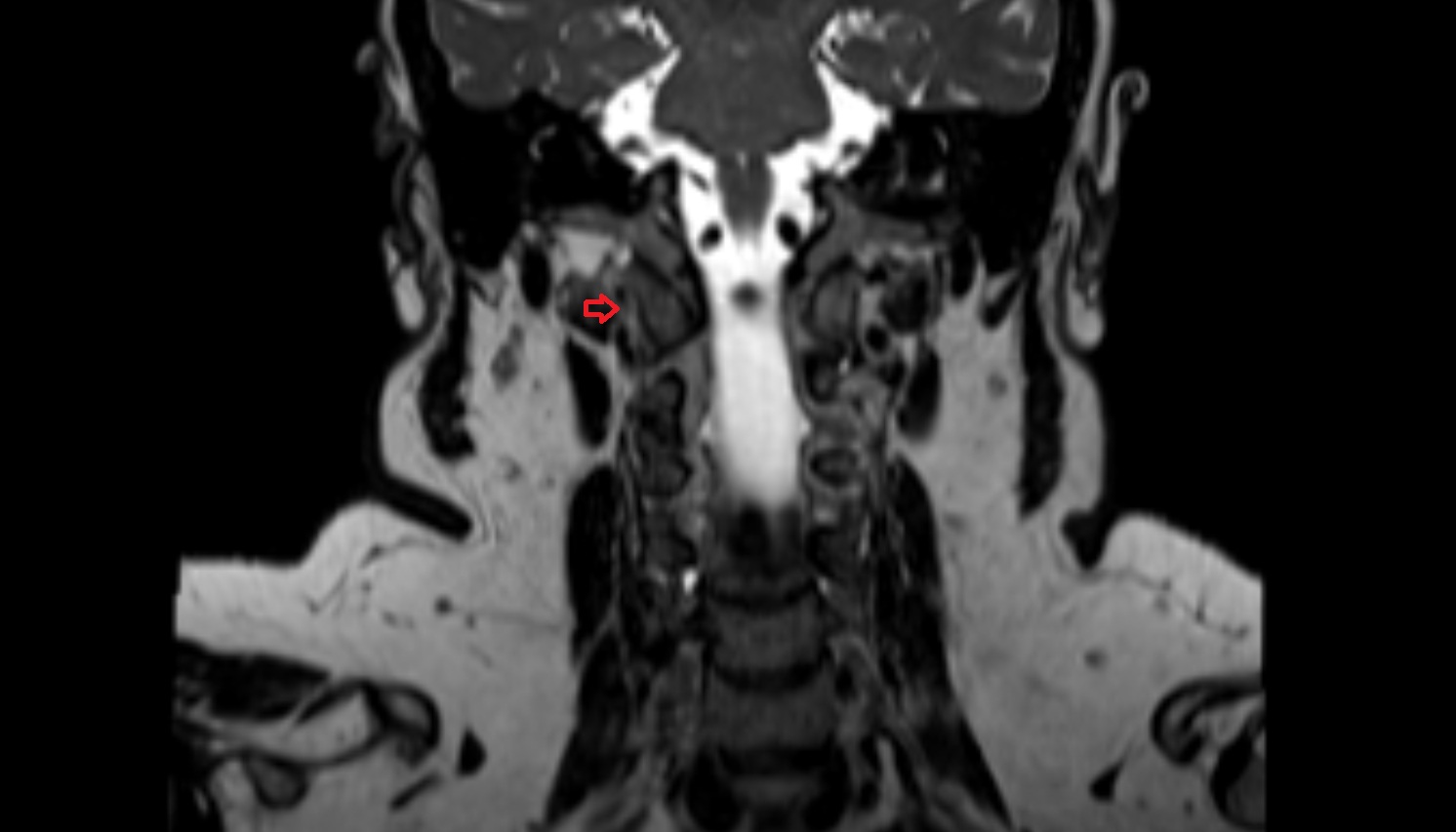 Right vertebral artery (atlantic part)  mri coronal image -img-00000-00000_00001
