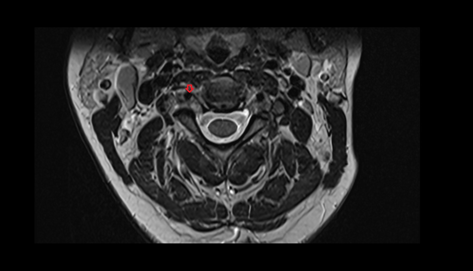 Right vertebral artery (cervical part) mri axial image