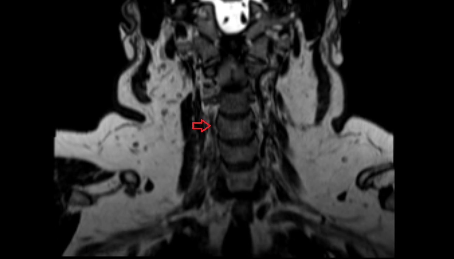 Right vertebral artery (cervical part)  mri coronal image -img-00000-00000