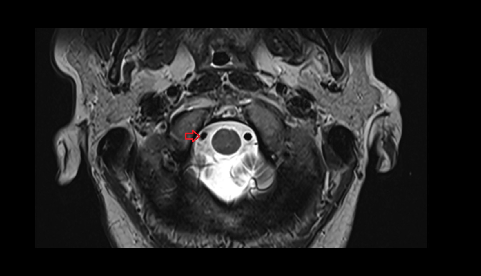 Right vertebral artery (intracranial part)