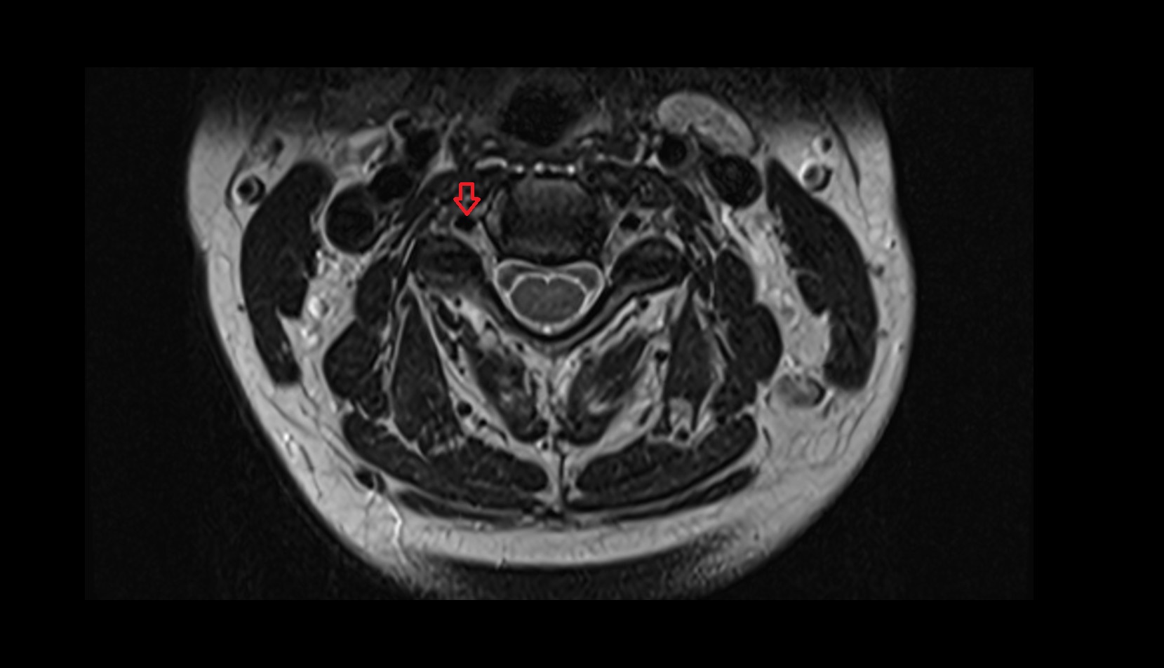 Right vertebral artery mri axial image