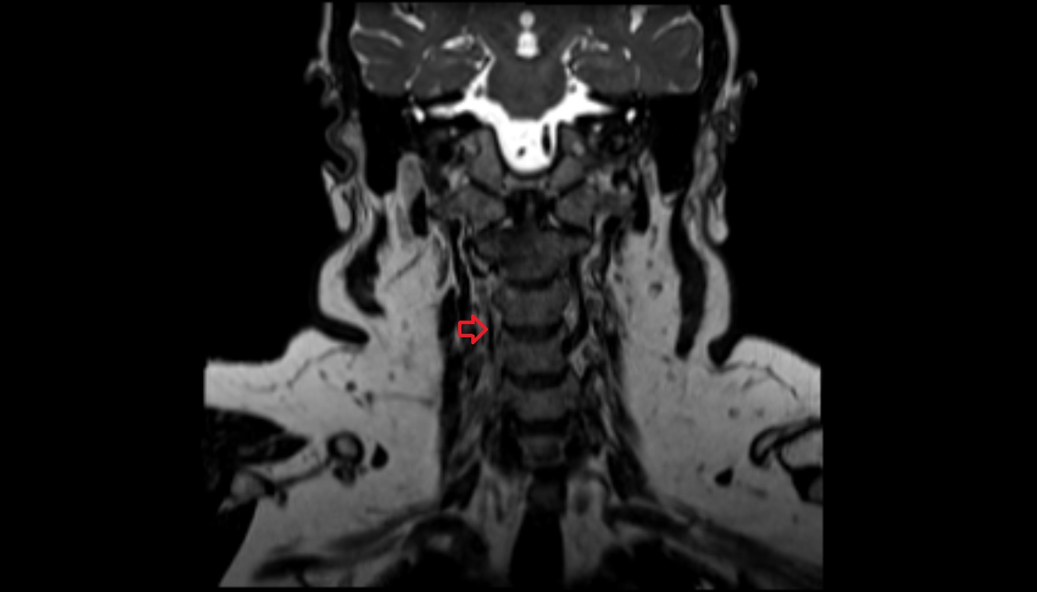 Right vertebral artery  mri coronal image -img-00000-00000