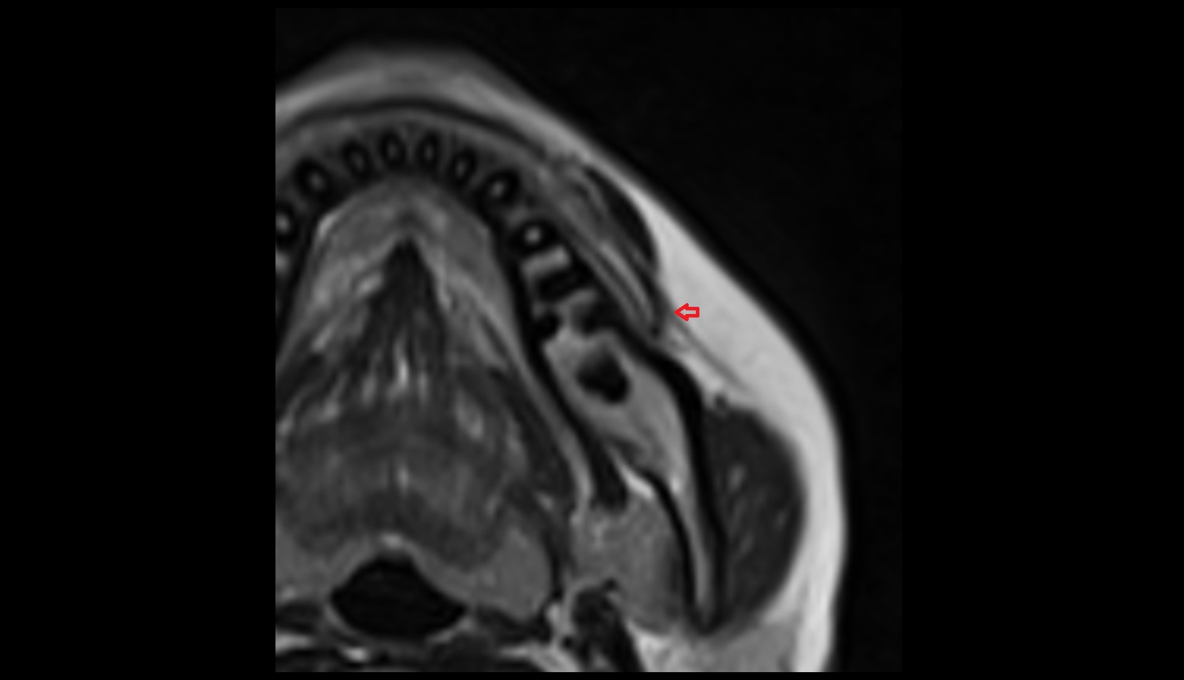 Risorius muscle mri axial image