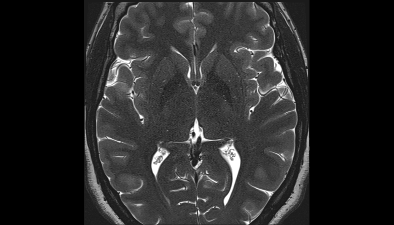 Rolandiс artery (central) mri axial  image -img-00000-00000