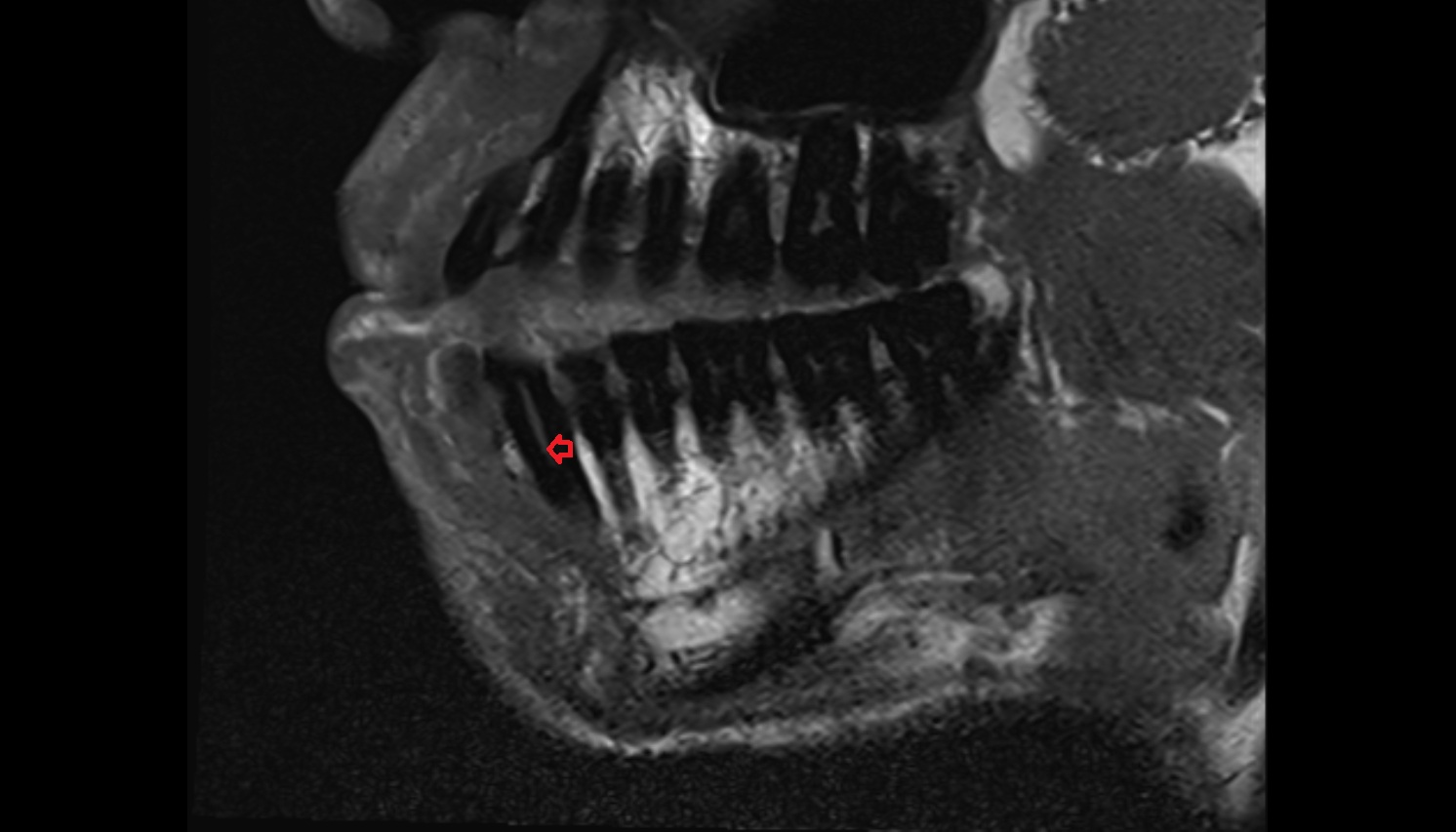 Root Canal of Lower Canine Tooth  mri sagittal  image -img-00000-00000