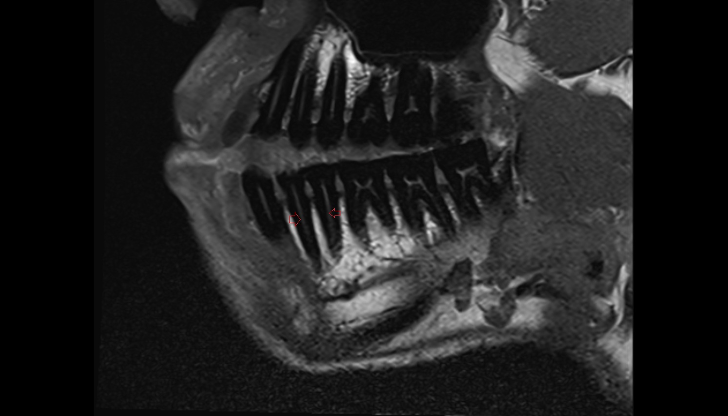 Root canal of lower premolar tooth  mri sagittal  image -img-00000-00000