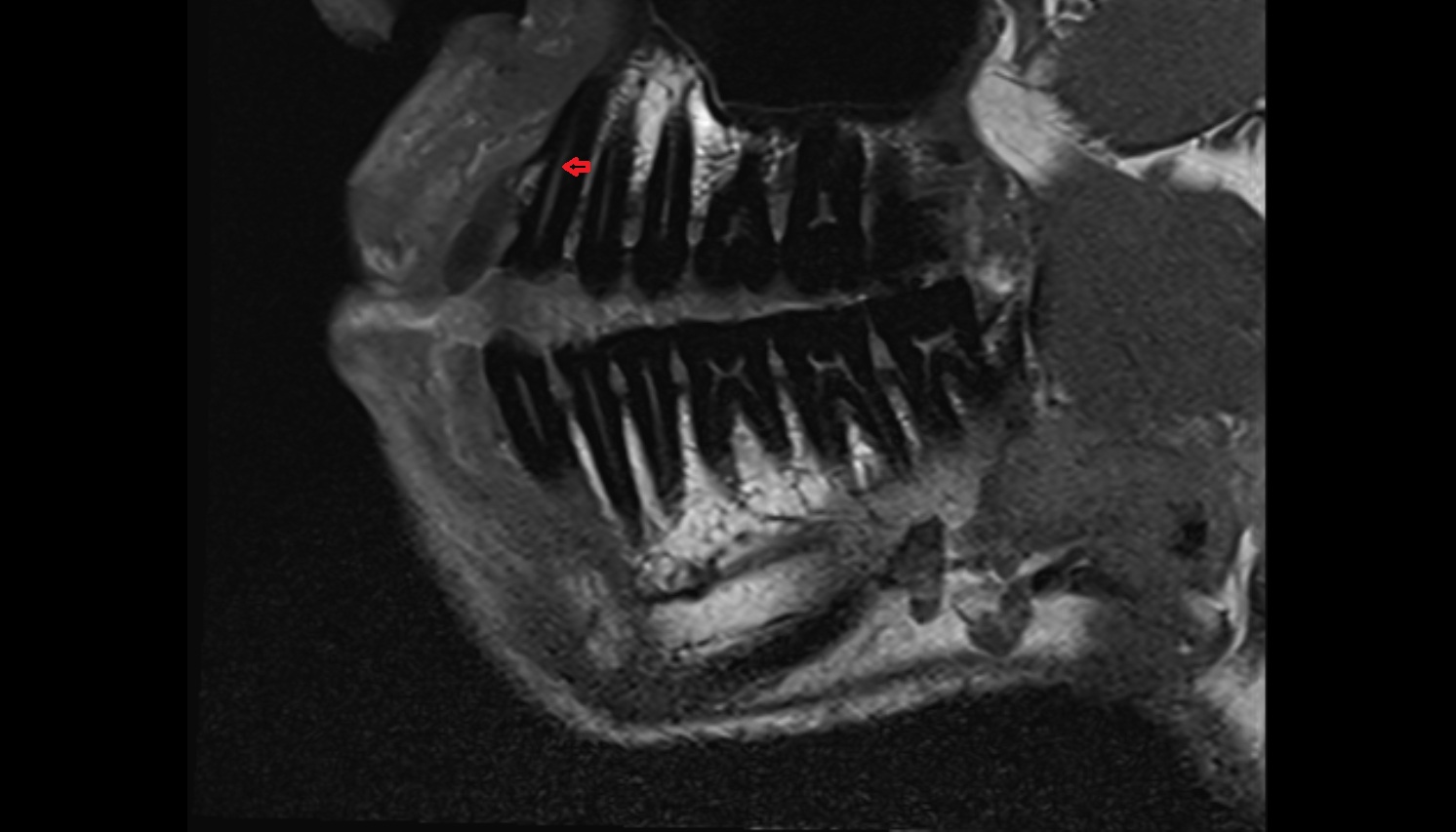 Root canal of upper canines tooth  mri sagittal  image -img-00000-00000