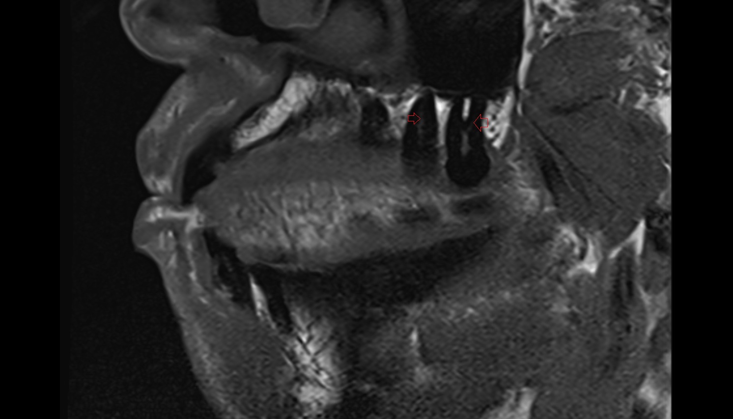 Root canal of upper molar tooth  mri sagittal  image -img-00000-00000