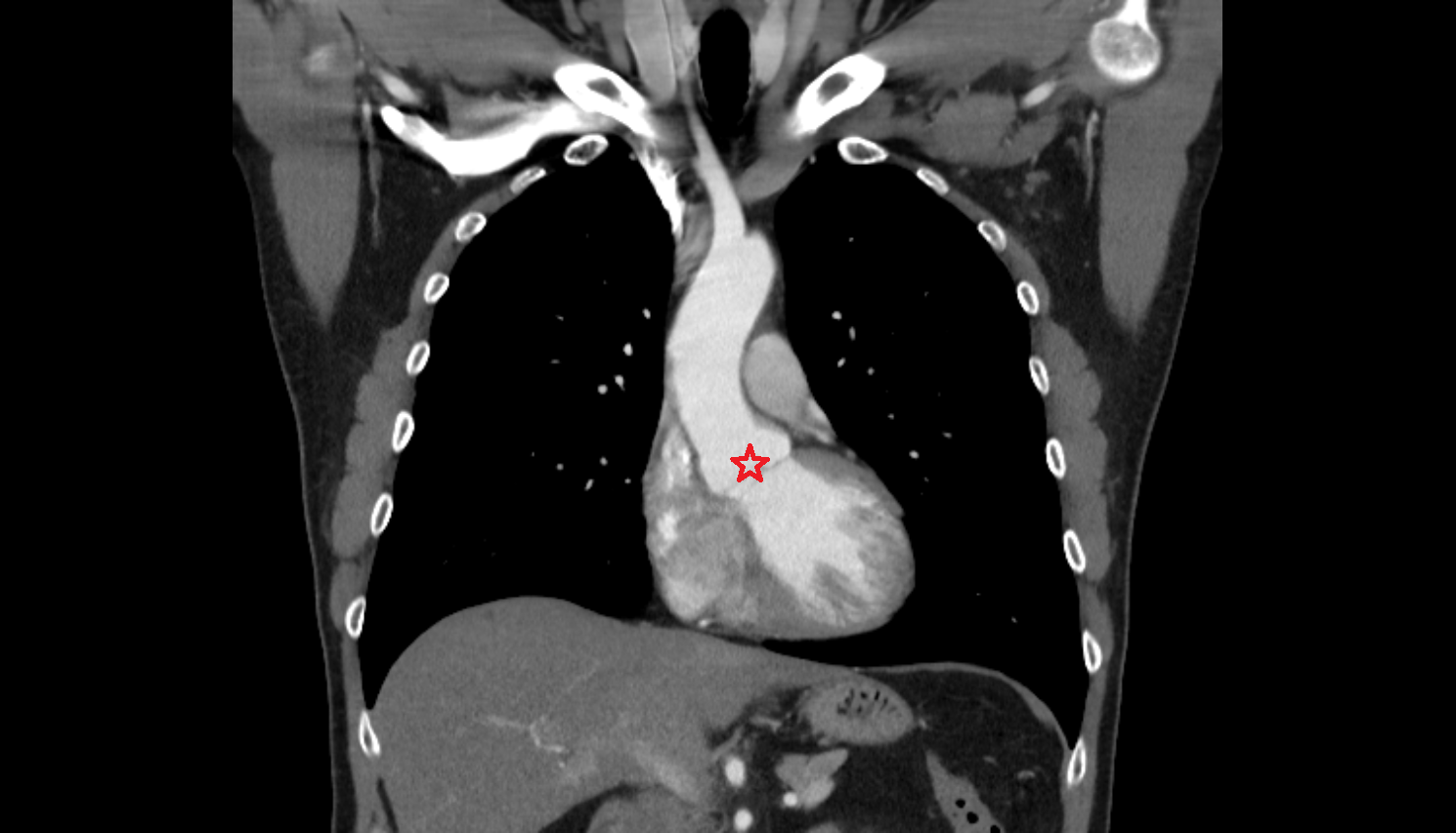 Root of aorta Anatomy, Location and Imaging Appearance CT anatomy image -img-00000-00000