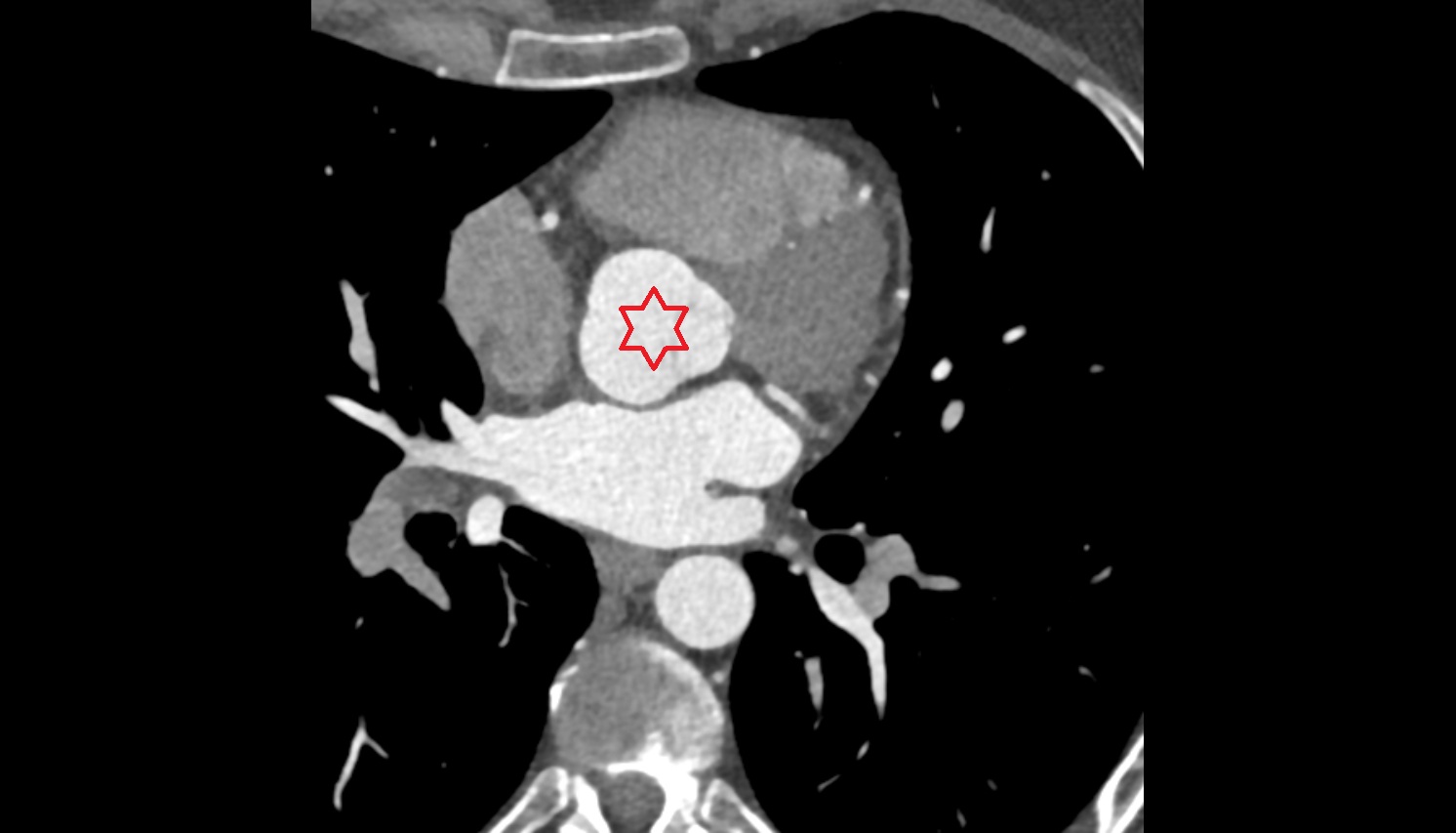 Root of aorta ct  axial  image -img-00000-00000