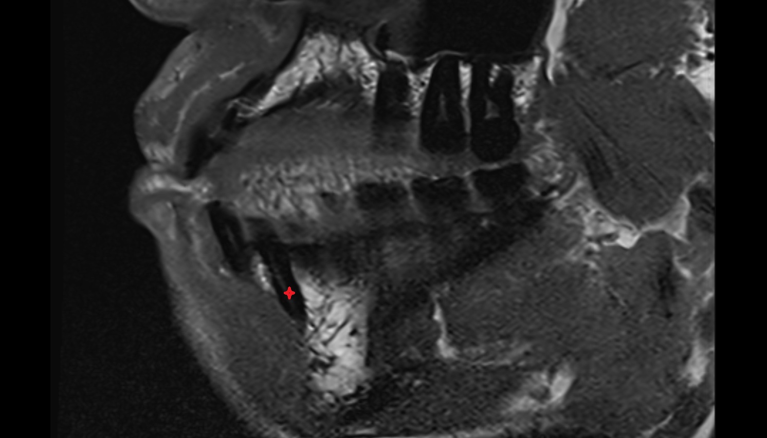 Root of lower canines tooth mri sagittal  image -img-00000-00000_00001