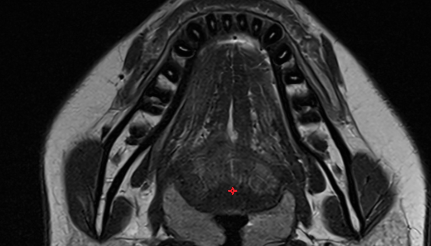 Root of tongue mri axial image -img-00000-00000
