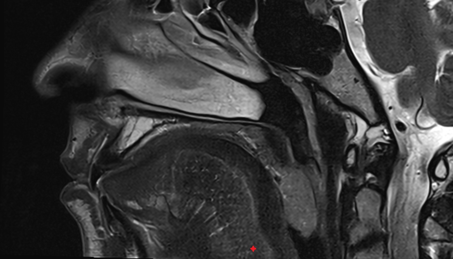 Root of tongue mri sag image -img-00000-00000
