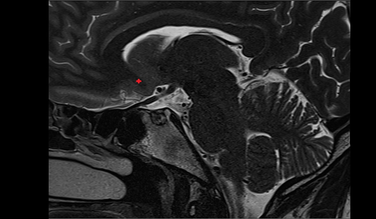 Rostrum of corpus callosum mri 3t sagittal image