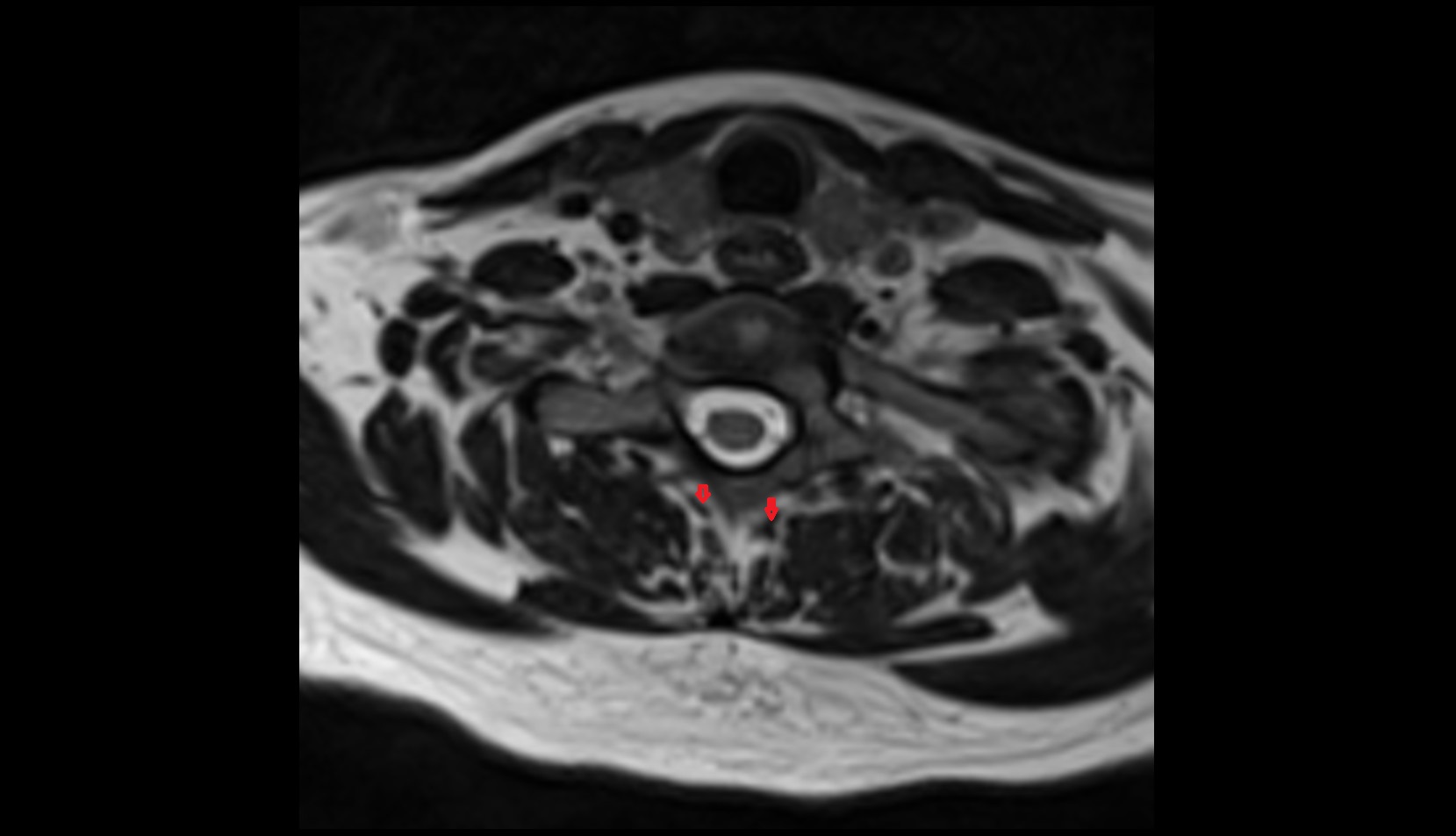 Rotatores cervicis muscle mri axial image