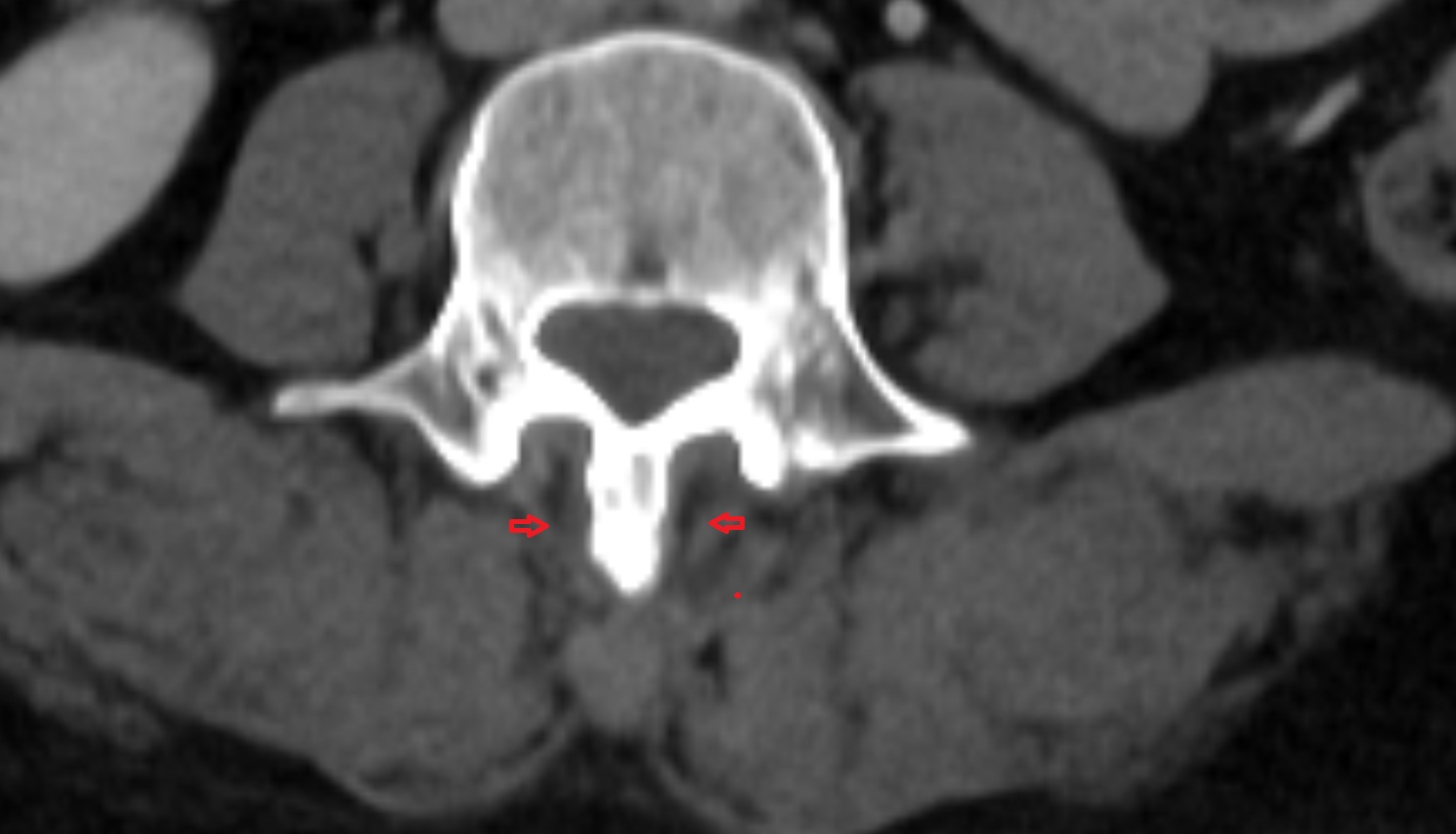 Rotatores lumborum muscles   cti  axial  anatomy  image-img-00000-00000