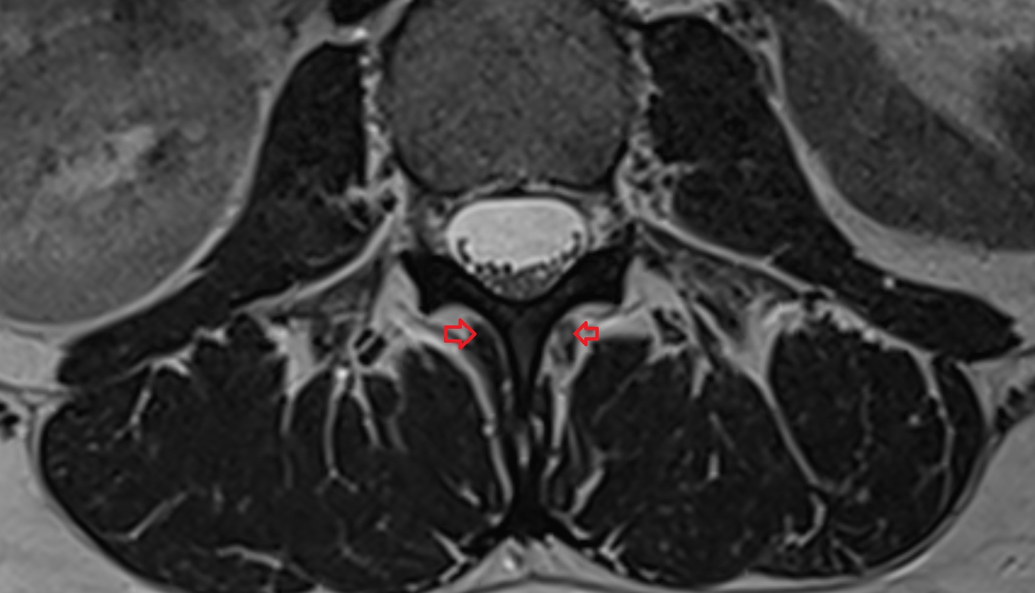 Rotatores lumborum muscles   mri  axial  anatomy  image-img-00000-00000