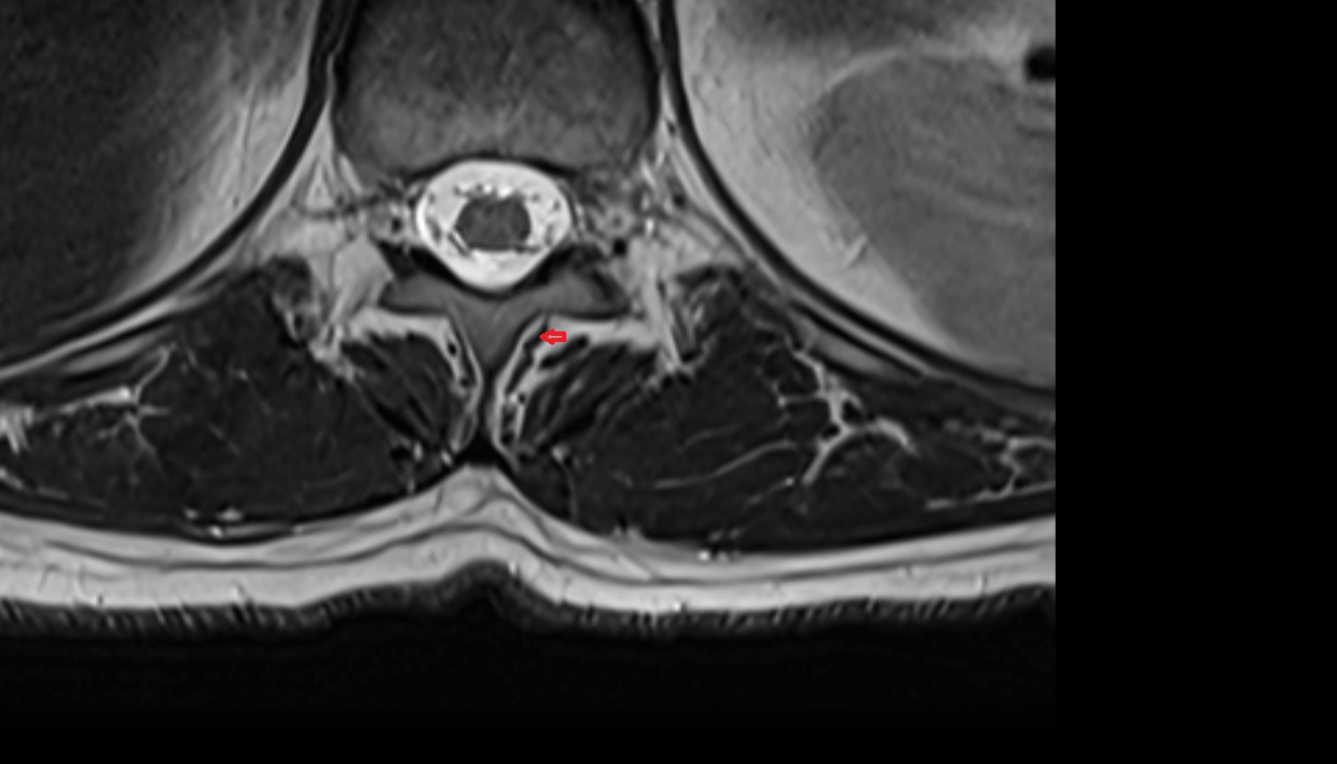 Rotatores muscle  anatomy MRI axial  image -img-00000-00000
