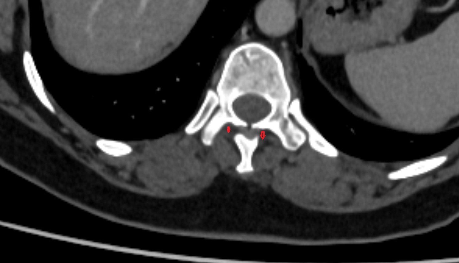 Rotatores thoracis muscles  ct axial  anatomy  image-img-00000-00000