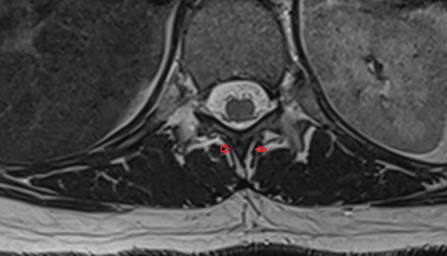 Rotatores thoracis muscles  mri  axial  anatomy  image-img-00000-00000