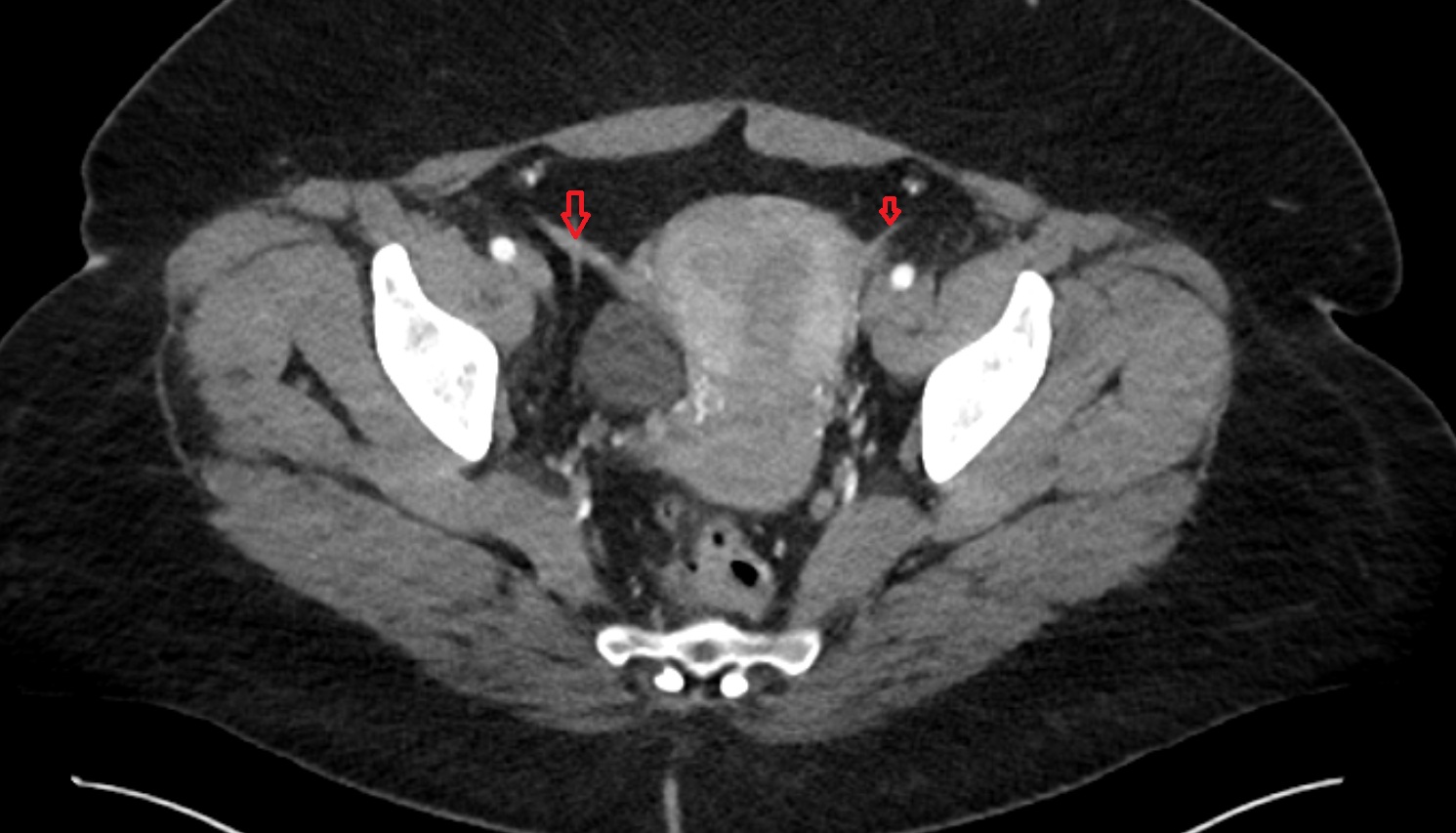 Round ligament of the uterus  CT axial image  image anatomy  image