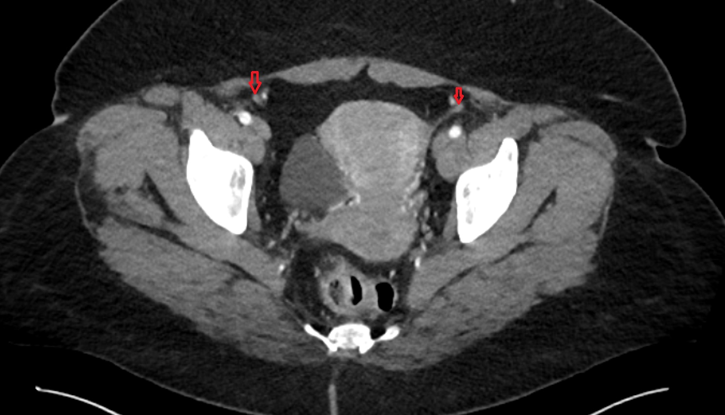 Round ligament of the uterus  CT axial image  image anatomy  image