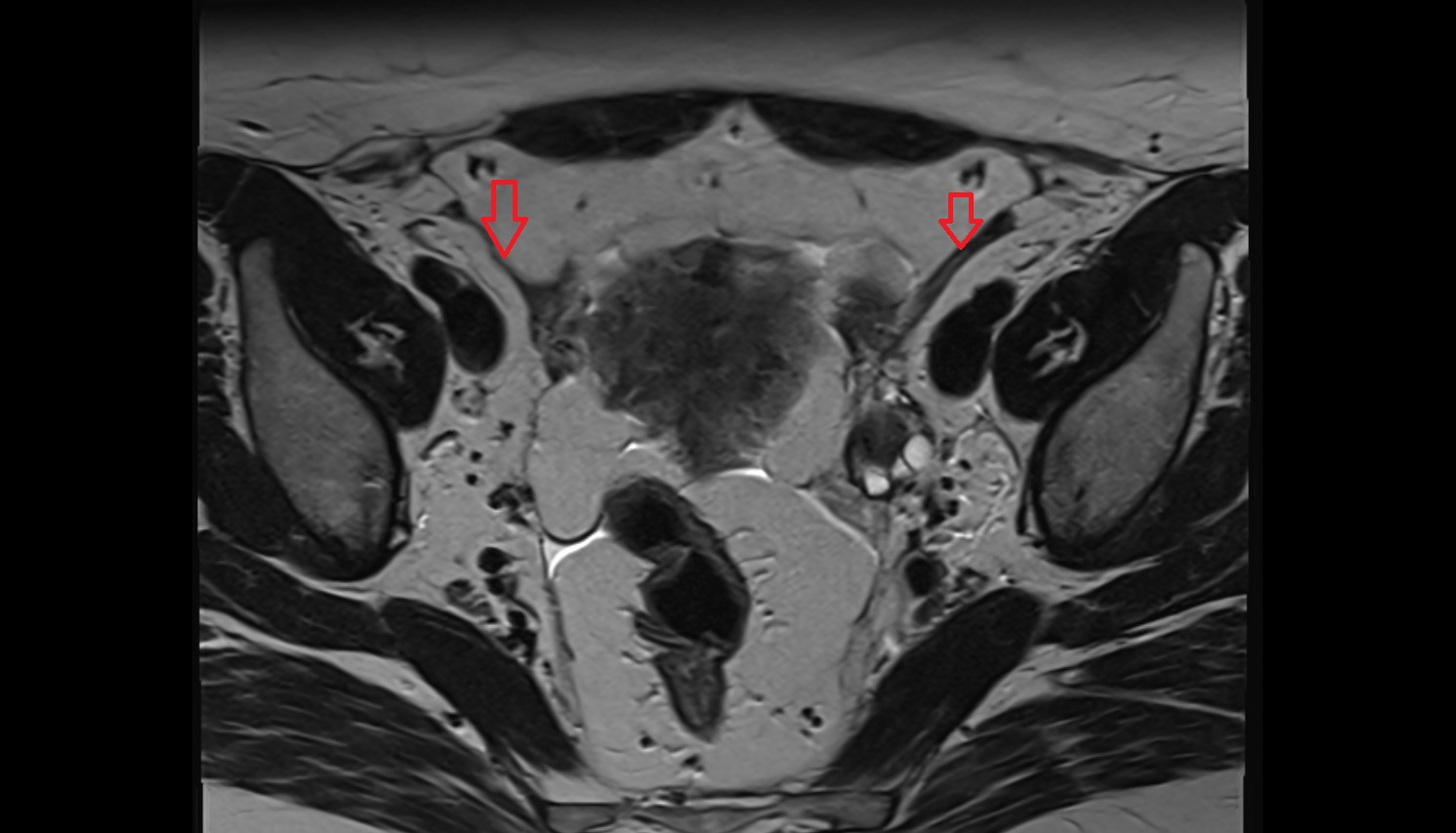 Round ligament of the uterus  mri axial anatomy  image 2