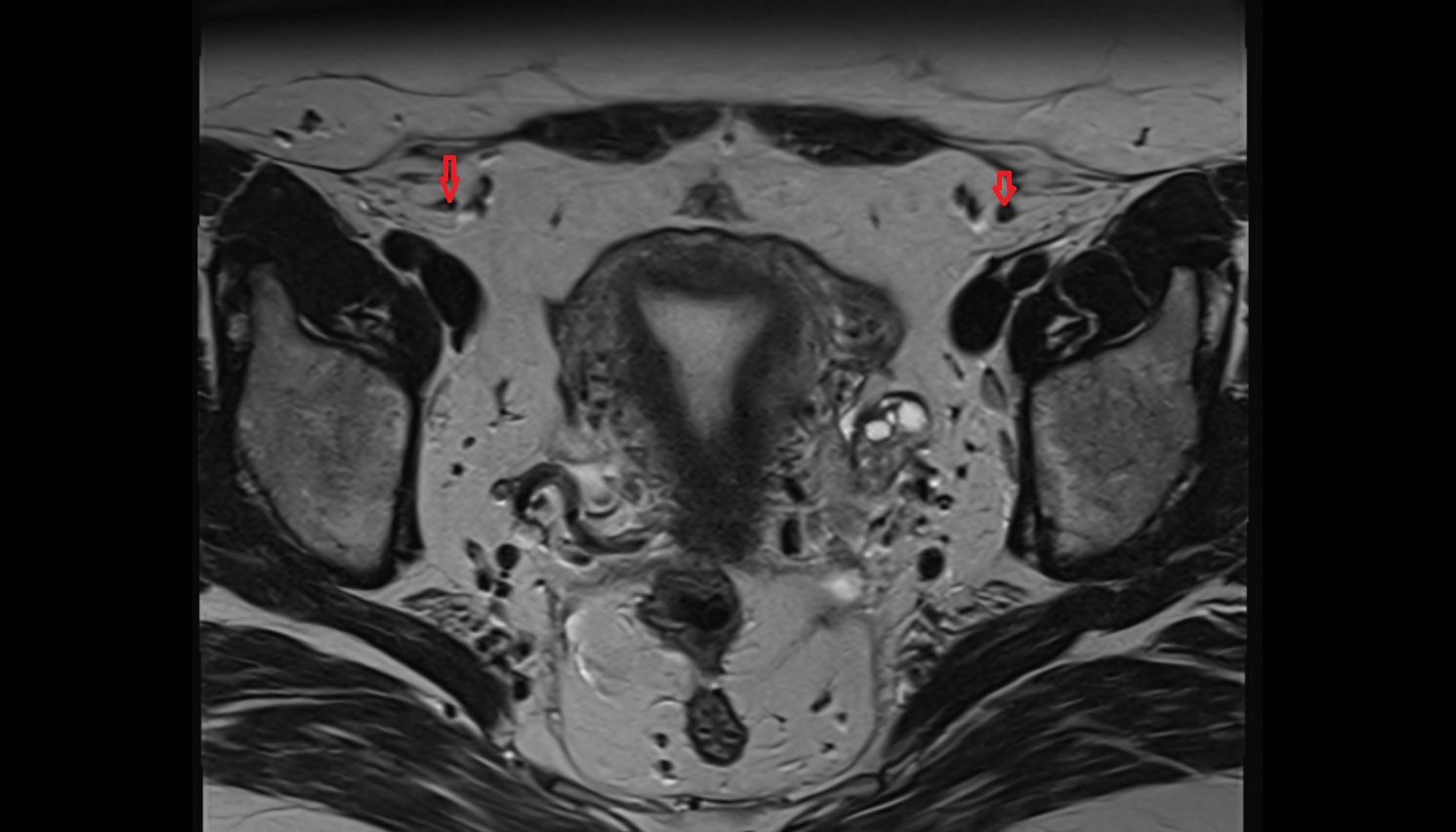 Round ligament of the uterus  mri axial  anatomy  image 1