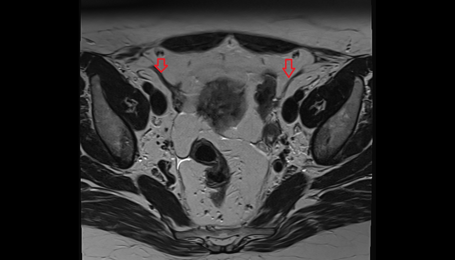 Round ligament of the uterus  mri axial  anatomy  image 3