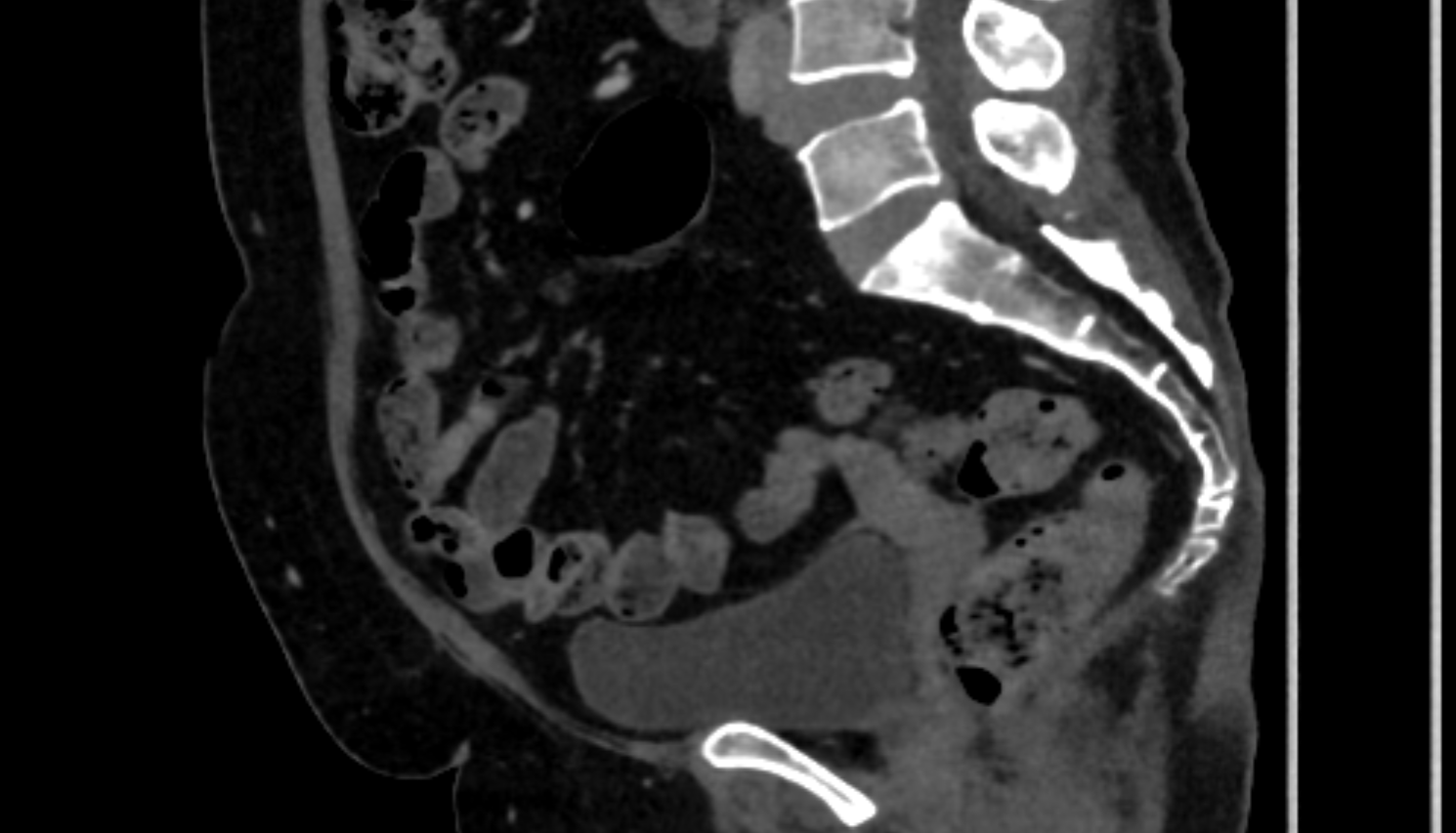 Sacral Spine CT SAG  anatomy  Location and Imaging Appearance  -img-00000-00000