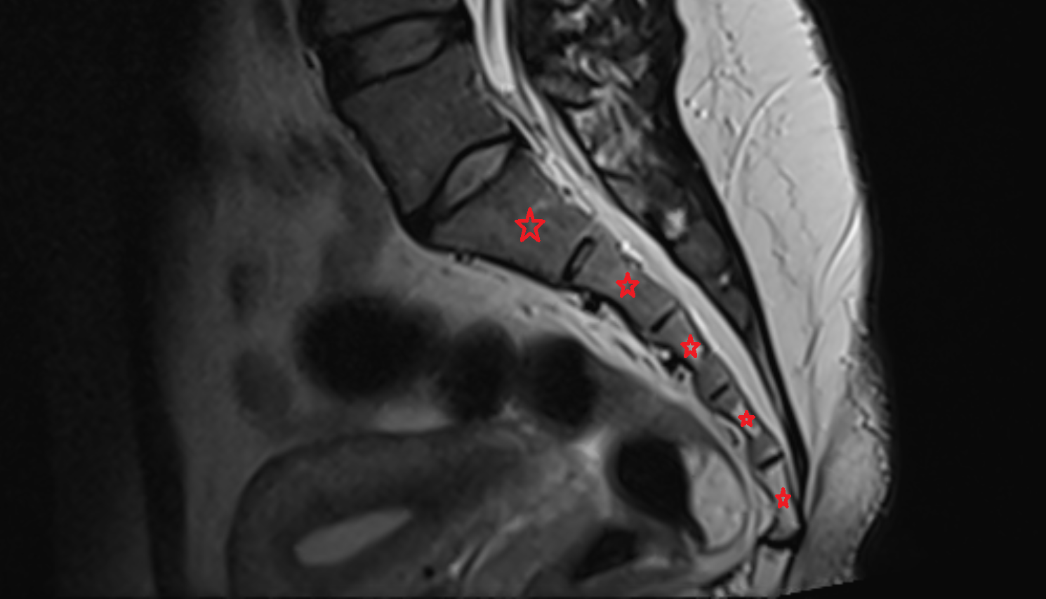 Sacral Spine MRI SAG  anatomy  Location and Imaging Appearance  -img-00000-00000