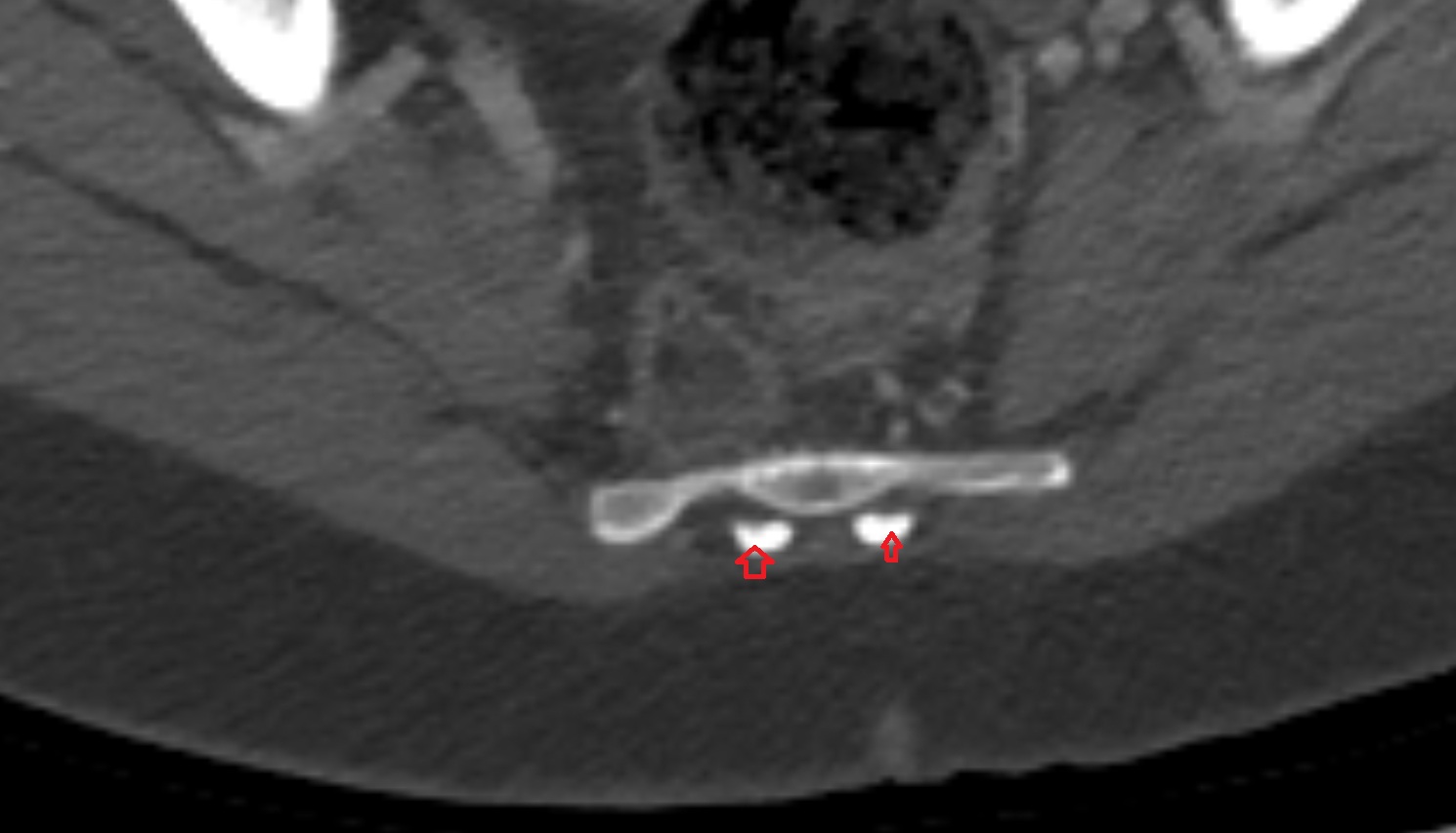 Sacral cornu (sacral horn)  ct  axial   anatomy  image-img-00000-00000