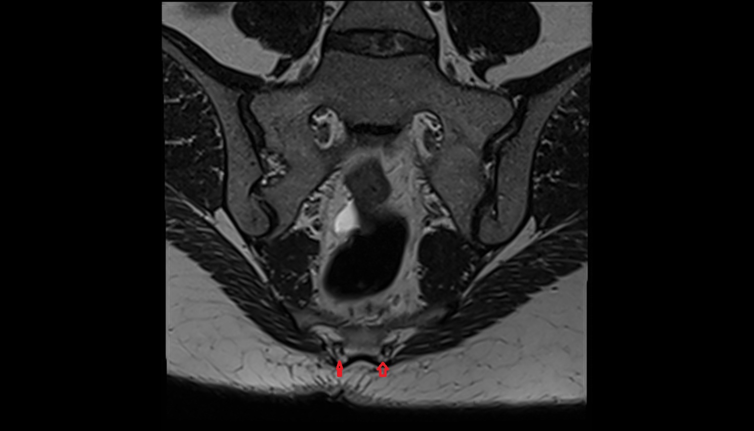 Sacral cornu (sacral horn)  mri coronal  anatomy  image-img-00000-00000