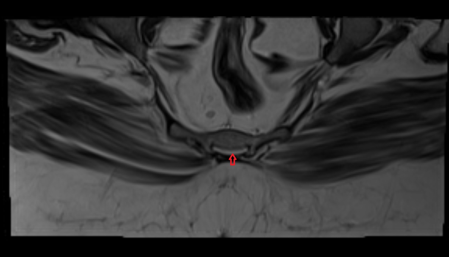 Sacral hiatus  mri coronal  anatomy  image