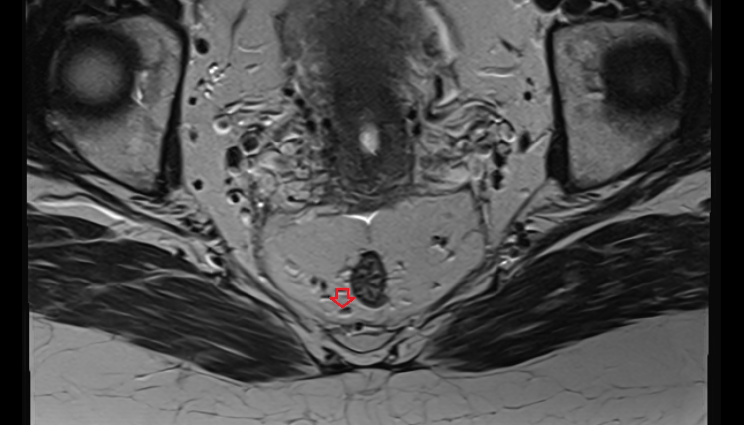 Sacral lymph nodes   MRI  axial  anatomy  image-img-00000-00000