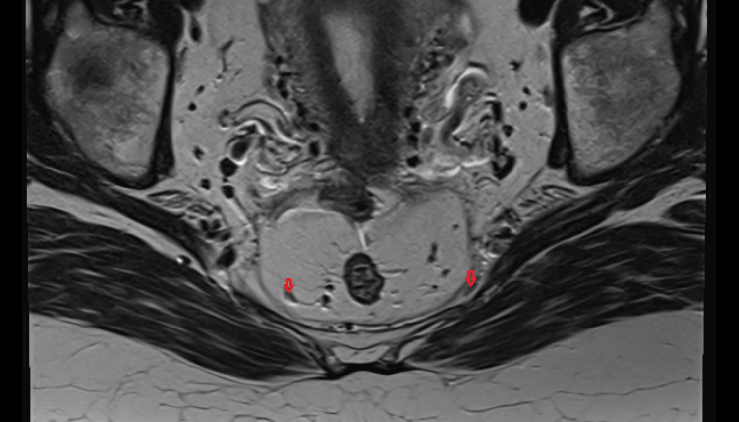 Sacral lymph nodes   MRI  axial  anatomy  image-img-00000-00000_00002