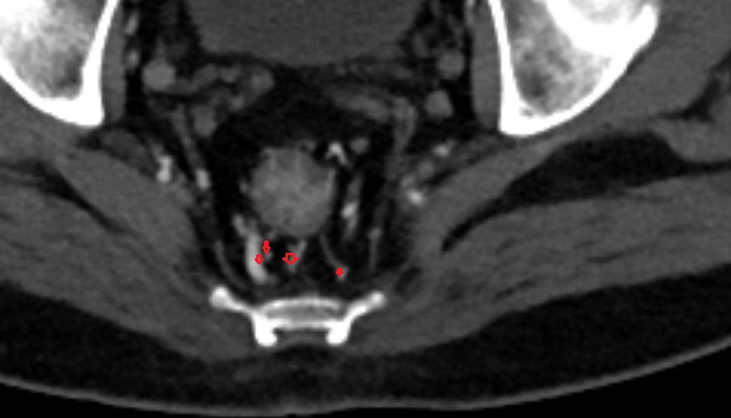 Sacral venous plexus  ct  axial  anatomy  image-img-00000-00000